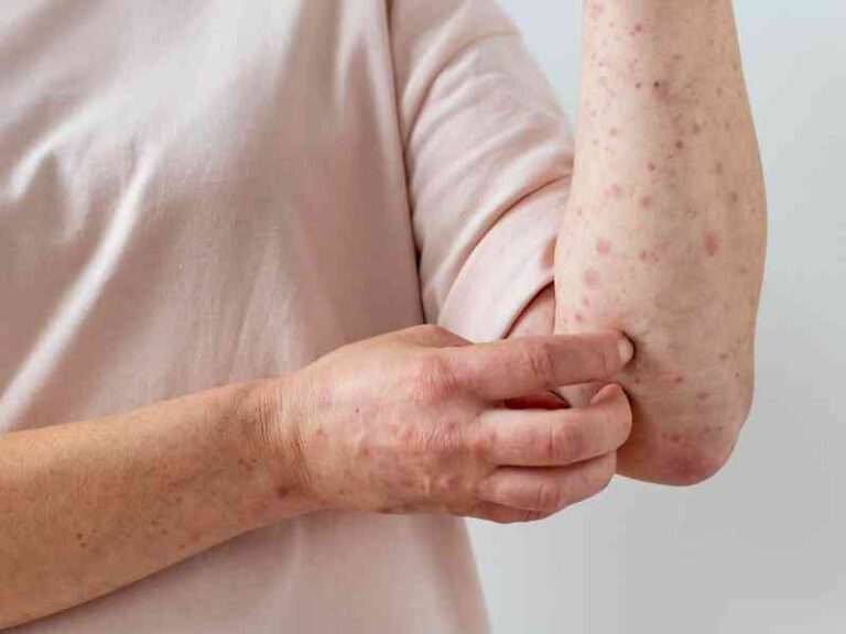 skin-allergy-on-person-s-arm